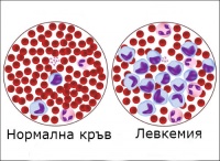C95.0 Остра левкемия с неуточнен клетъчен тип
