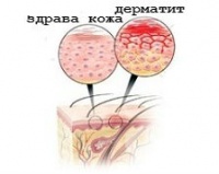 L30 Други дерматити