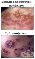 L10.8 Други видове пемфигус