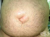 K42.0 ����� ������ � ������������� ��� ��������