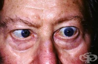 H49.2 �������� �� 6-�� ���� [n. abducent]