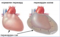 I31.3 Перикарден излив (невъзпалителен)
