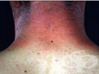 L56.2   [berloque dermatitis]