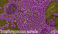 L08.0 Пиодермия