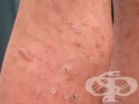 L41.1 Pityriasis lichenoides chronica