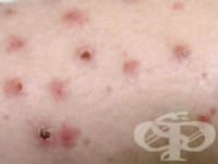 L41.0 Pityriasis lichenoides et varioliformis acuta