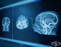 I69.8 Последици от други и неуточнени мозъчносъдови болести