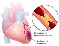 I22.0 Повторен инфаркт на миокарда на предната стена