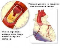 I22.8 Повторен инфаркт на миокарда с друга уточнена локализация