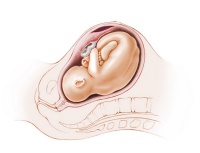 O45      [abruptio placentae]