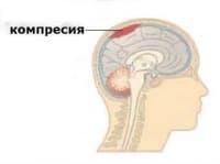 G93.5 Притискане на главния мозък