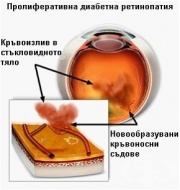 H36* Увреждания на ретината при болести, класифицирани другаде