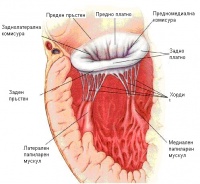 I23.4 Руптура на сухожилна хорда като текущо усложнение на острия инфаркт на миокарда