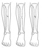 S82.2 �������� �� ������ [�������] �� �������