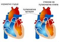 I37.0 Стеноза на пулмоналната клапа