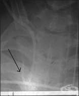 S25.2 ������ �� ������� vena cava