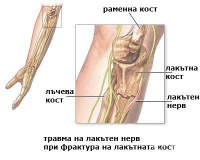 S54.0 Травма на лакътния нерв на ниво предмишница