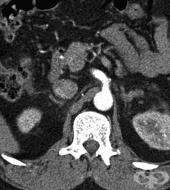 S35.2   truncus coeliacus   