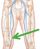 S75.2 ������ �� vena saphena magna �� ���� ����������� ����� � �����