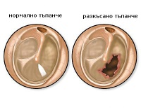 S09.2 Травматично разкъсване на тъпанчето