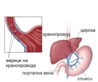 I85 Варици на хранопровода