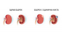 Q61.0 Вродена единична киста на бъбрека