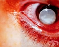 H40.6 Вторична глаукома, предизвикана от лекарствени средства