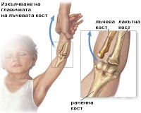 S53.0 Изкълчване на главичката на лъчевата кост