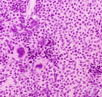 C96.2 Злокачествен мастоклетъчен тумор
