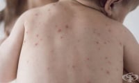 СЗО: Съществува сериозен риск от възникването на огнища от морбили по света