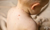 Нараства броят на случаите на морбили в Съединените щати