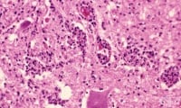 Ню Йорк потвърди първия от десет години случай на полиомиелит