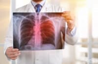 Около 4200 българи годишно се сблъскват с диагнозата рак на белия дроб