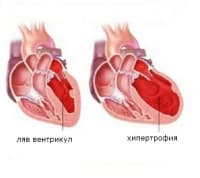 Левостранна сърдечна недостатъчност