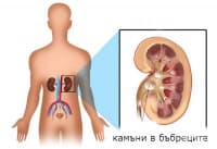 Клинична патология на бъбречнокаменна болест