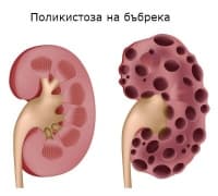 Клинична патология на поликистоза на бъбреците