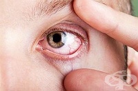 3 съвета от специалисти при възпаление на очите