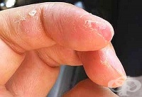 Ако имате екзема на пръстите, ги мажете с прополисов вазелин и спете с ръкавици