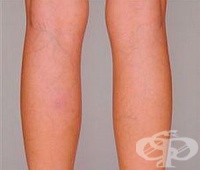 Излекувайте разширените вени по 3 уникални рецепти с люспи от лук