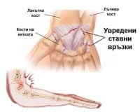 Навяхване на китката в спорта