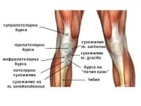 Бурсит в областта на коляното при спортисти