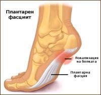 Плантарен фасциит в спорта