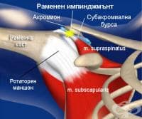 Раменен импинджмънт в спорта (Impingement Syndrome)