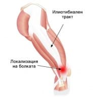 Синдром на илиотибиалния тракт