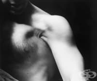 Разкъсване на пекторалиса