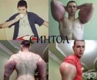 21-годишен руски бодибилдър рискува живота си след инжектиране на синтол в мускулите си