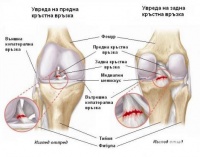 Предотвратяване на травмите на кръстните връзки при спортуващите деца