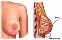 Абсцес на гърдата