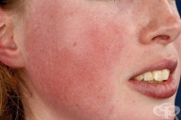 Червени бузи