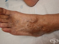 Кафяви петна по краката